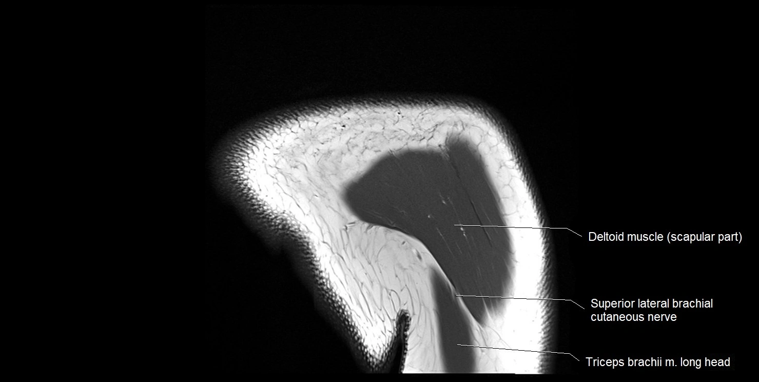 mri shoulder coronal cross sectional anatomy image 21.webp